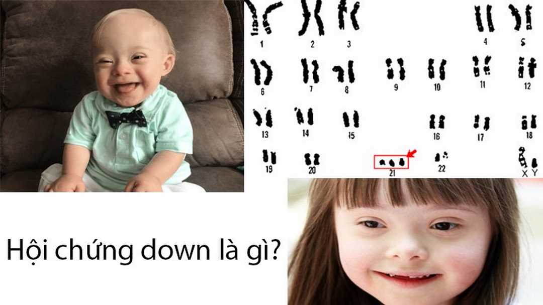 Bệnh Down hay Trisomy 21 là bệnh dư thừa một NST ở vị trí số 21