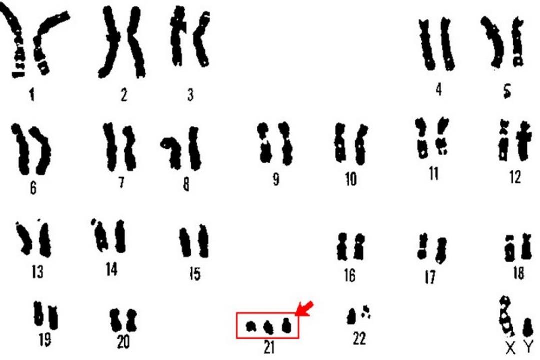 Có đến 95% trẻ mắc hội chứng Down xuất phát từ Trisomy 21