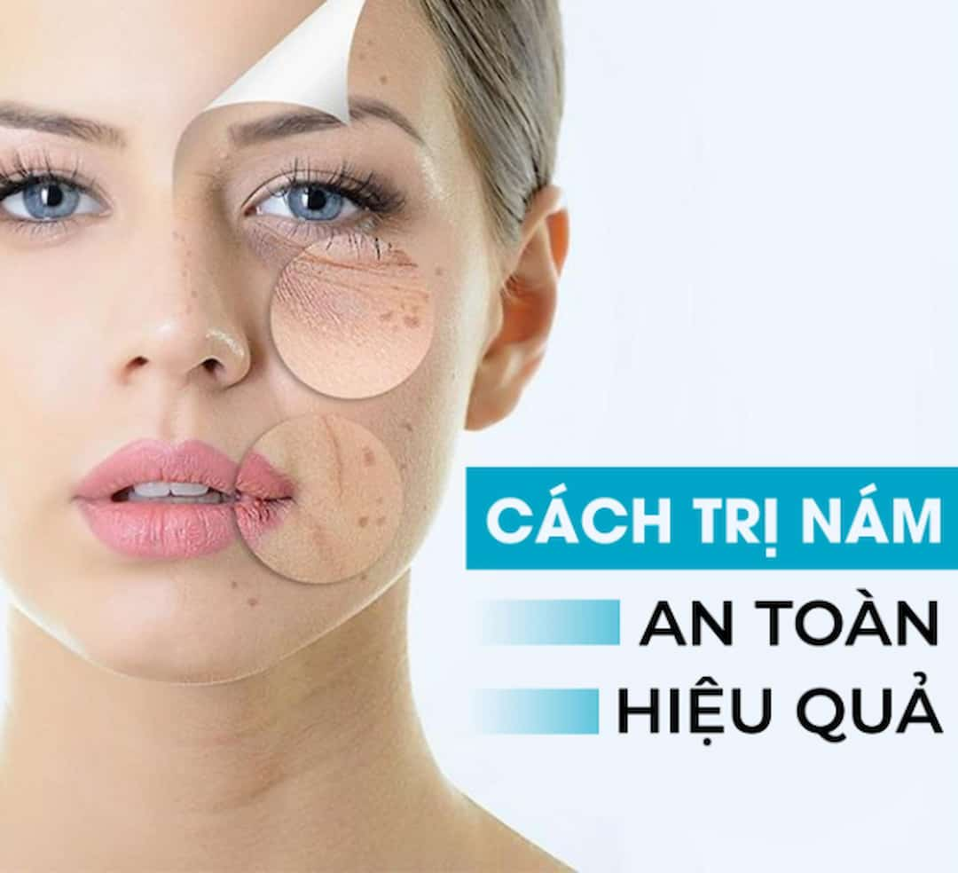 Cách trị nám nắng bằng dân gian dễ làm, dễ thực hiện