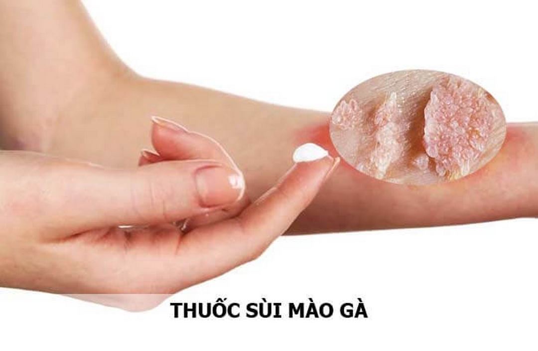 Sùi mào gà có thể dùng thuốc không?