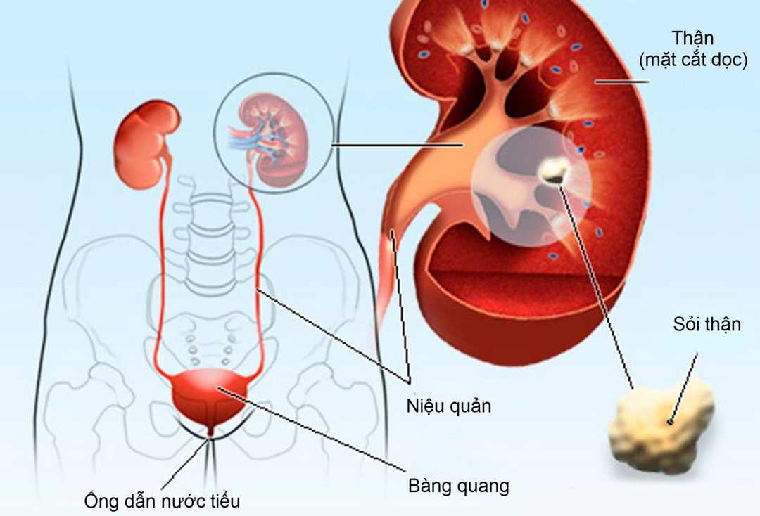 Căn bệnh nguy hiểm mang tên “ sỏi thận”