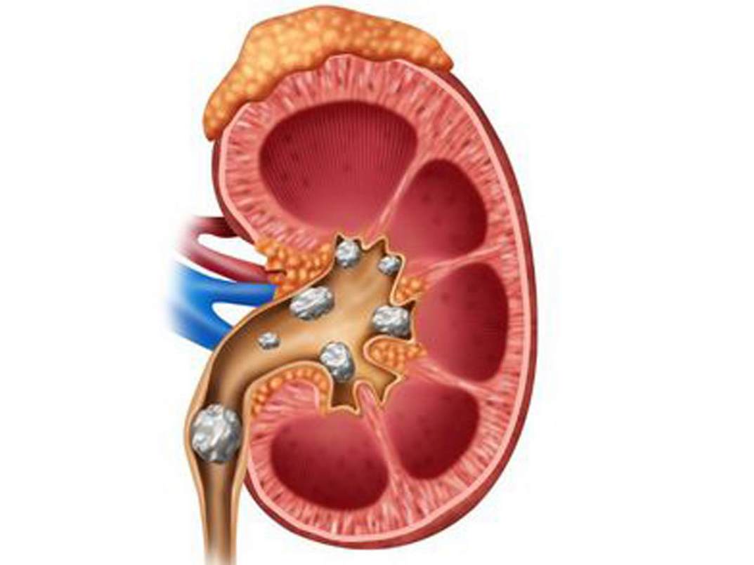 Sự tổn thương của thận