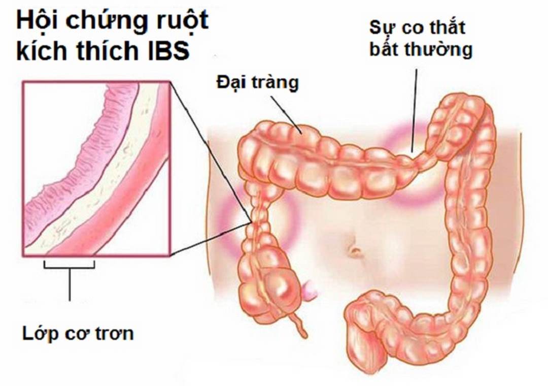 Hội chứng ruột kích thích cũng sẽ dẫn đến bệnh lý trên 