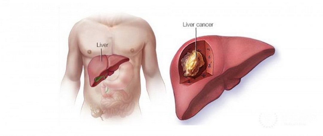Ung thư về gan nguy hại ra sao?