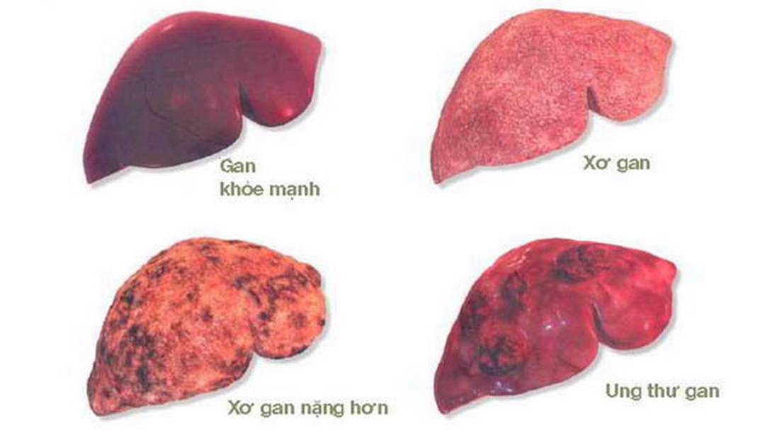 Tình trạng gan khỏe mạnh và gan bất thường