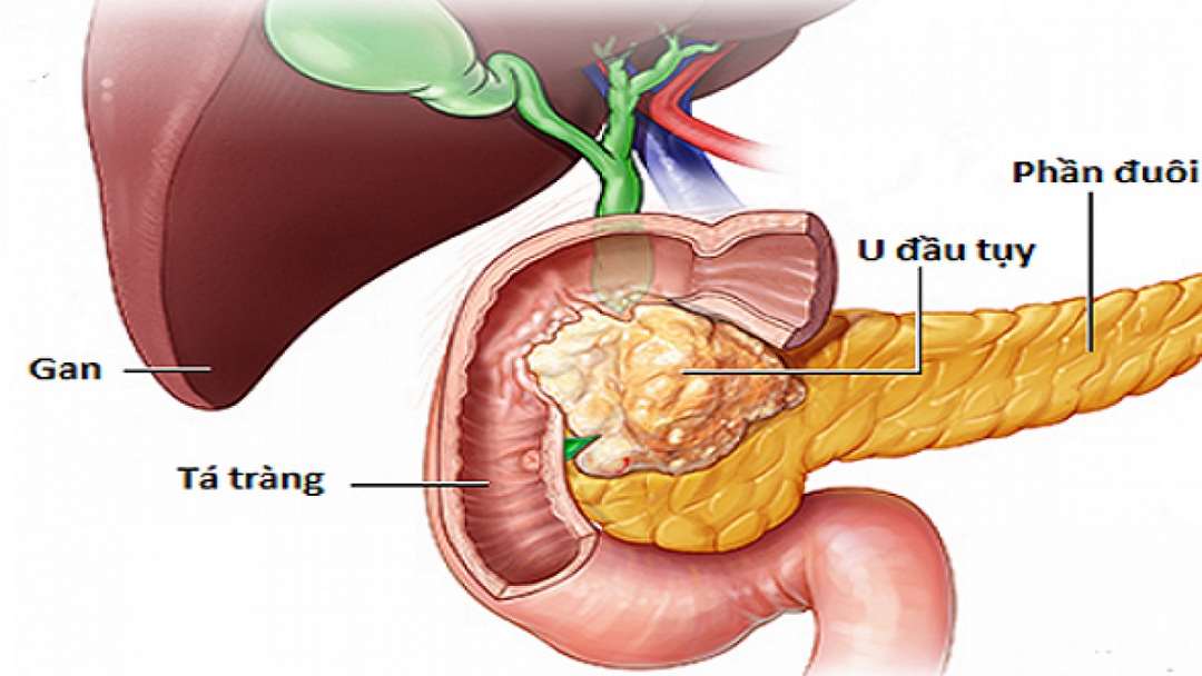 Ung thư tụy thuộc dạng mô rất phổ biến 