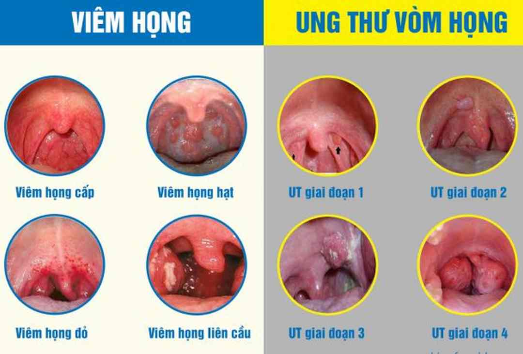 Một số tiến triển về ung thư tại vòm họng