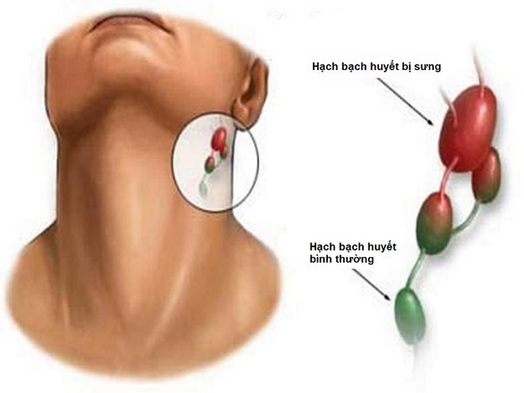 Một số dấu hiệu để nhận dạng ung thư 