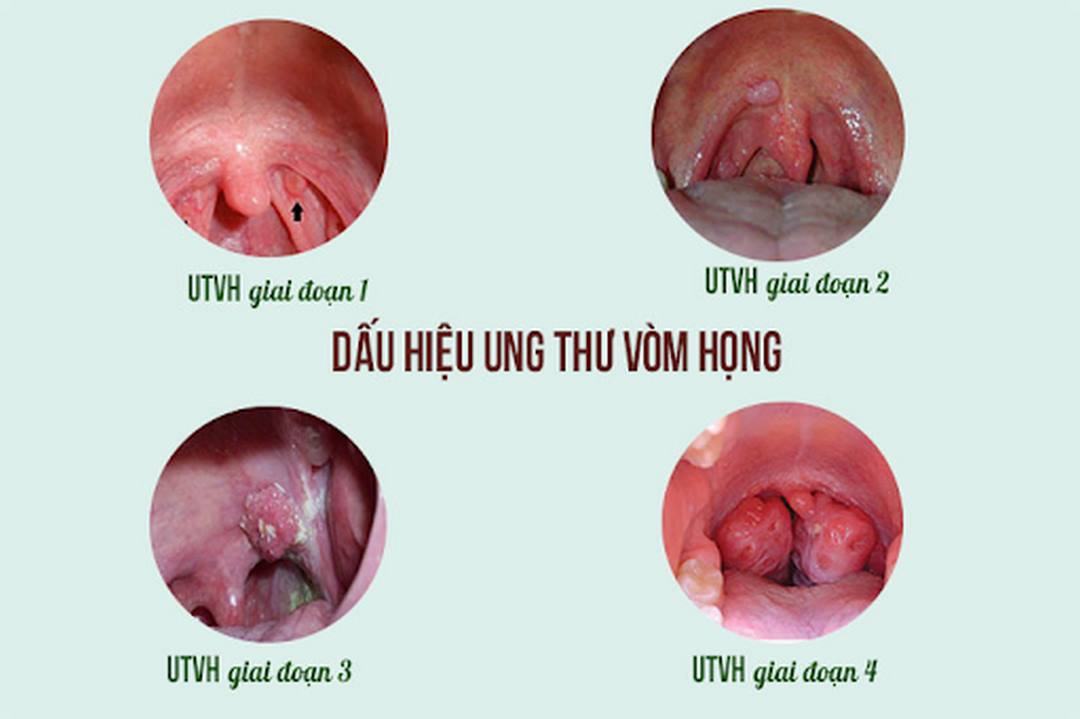 Một số tác nhân gây ra ung thư ở các giai đoạn