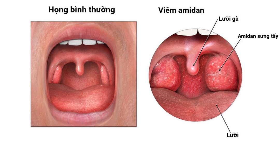 Phát hiện viêm amidan sớm nhất có thể