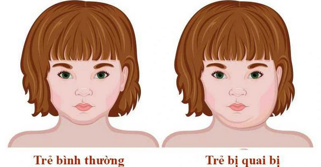 Tổng quan về bệnh quai bị