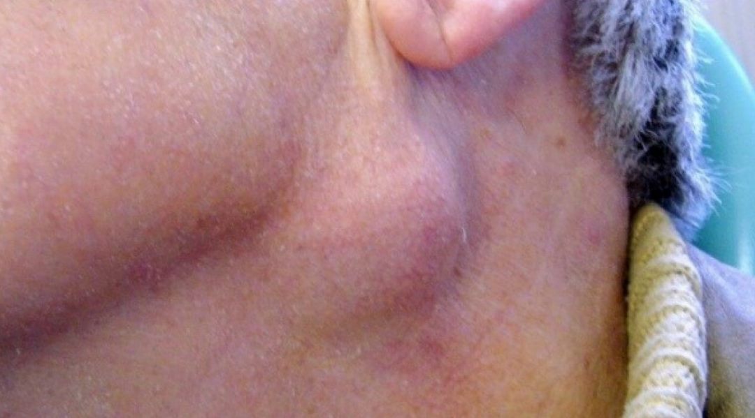 Ung thư mũi hầu (nasopharyngeal cancer – NPC)