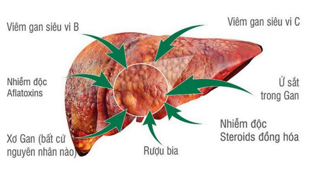 Nguyên nhân gây ung thư gan