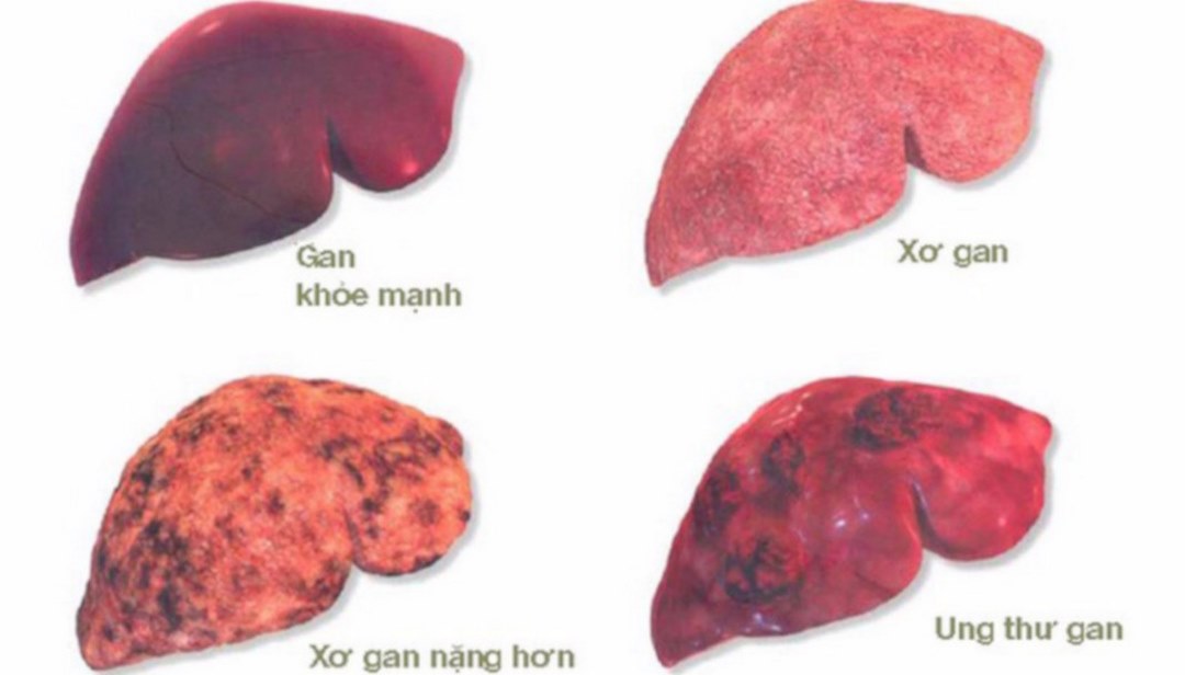 Ung thư gan có nguy hiểm không?