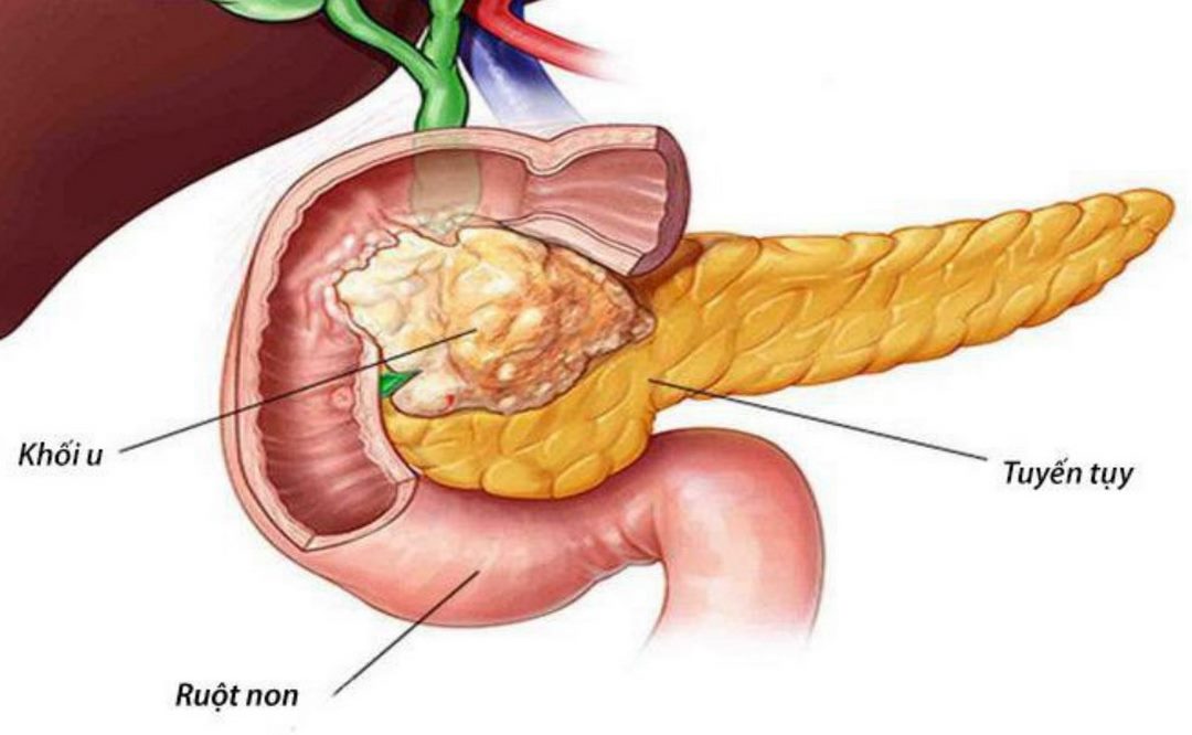 Tổng quan về ung thư tuyến tụy