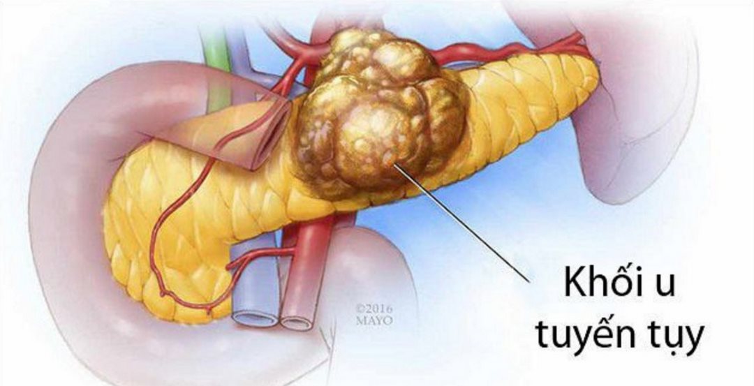 Ung thư tuyến Tụy ngoại tiết