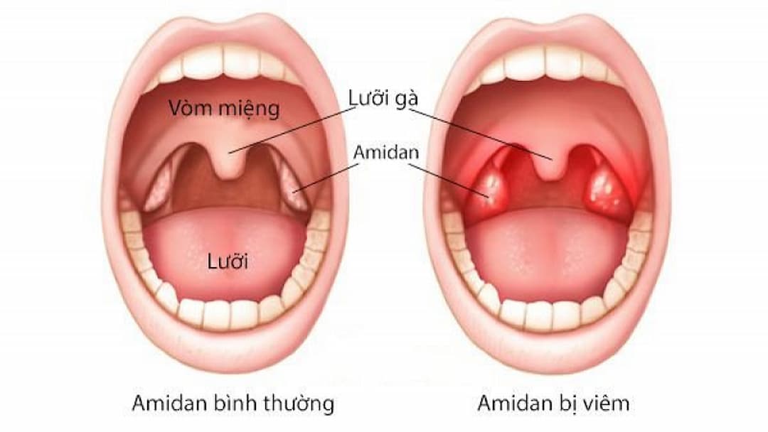 Một số lưu ý về việc sử dụng thuốc chữa viêm amidan