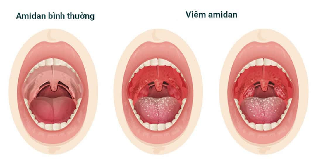 Viêm amidan khiến hơi thở của trẻ có mùi hôi