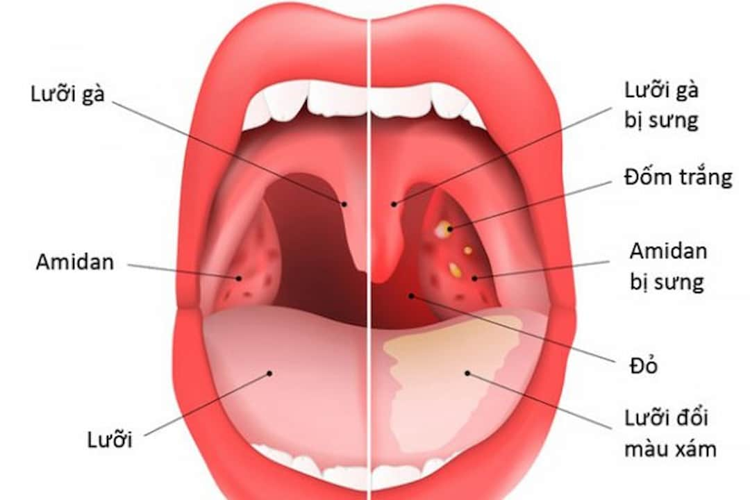  Amidan là một tổ chức lympho có vai trò miễn dịch