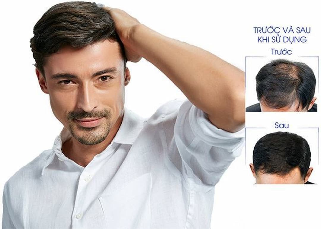 Cách mọc tóc nhanh cho nam từ nguyên liệu tự nhiên