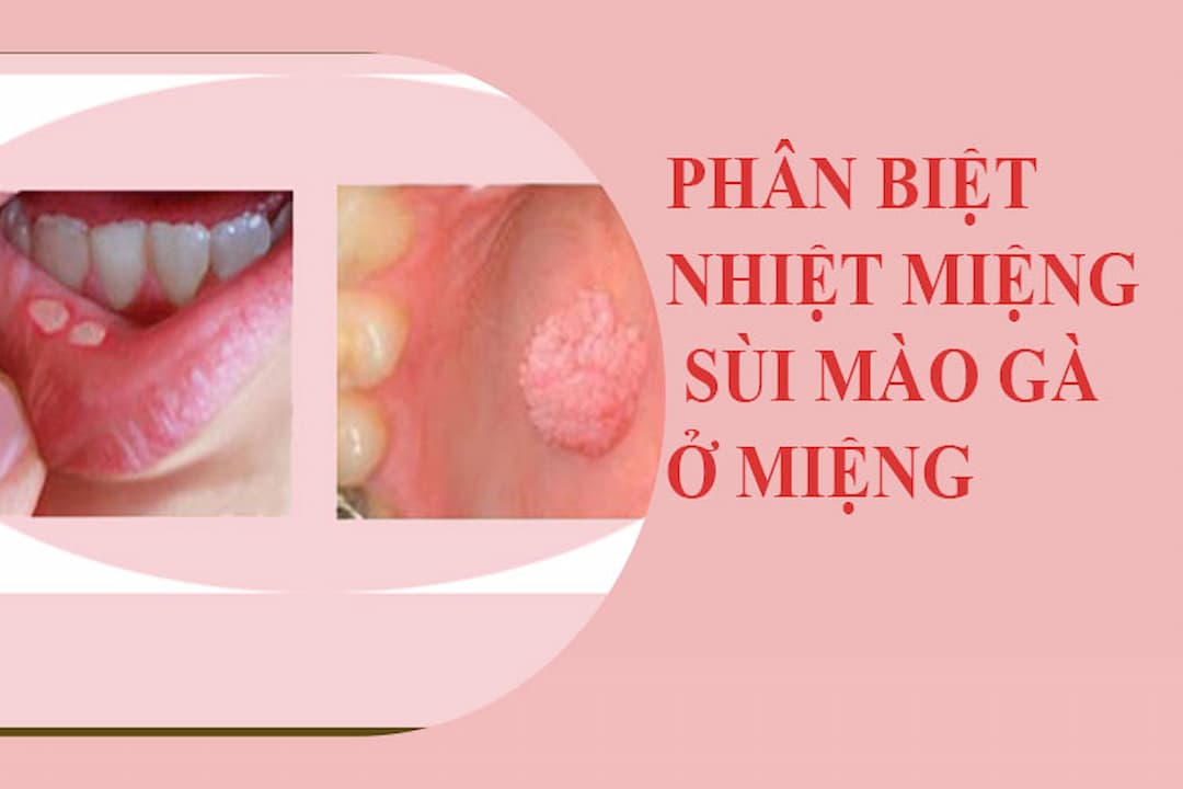 Phân biệt bệnh sùi mào gà ở miệng và nhiệt miệng để phòng tránh