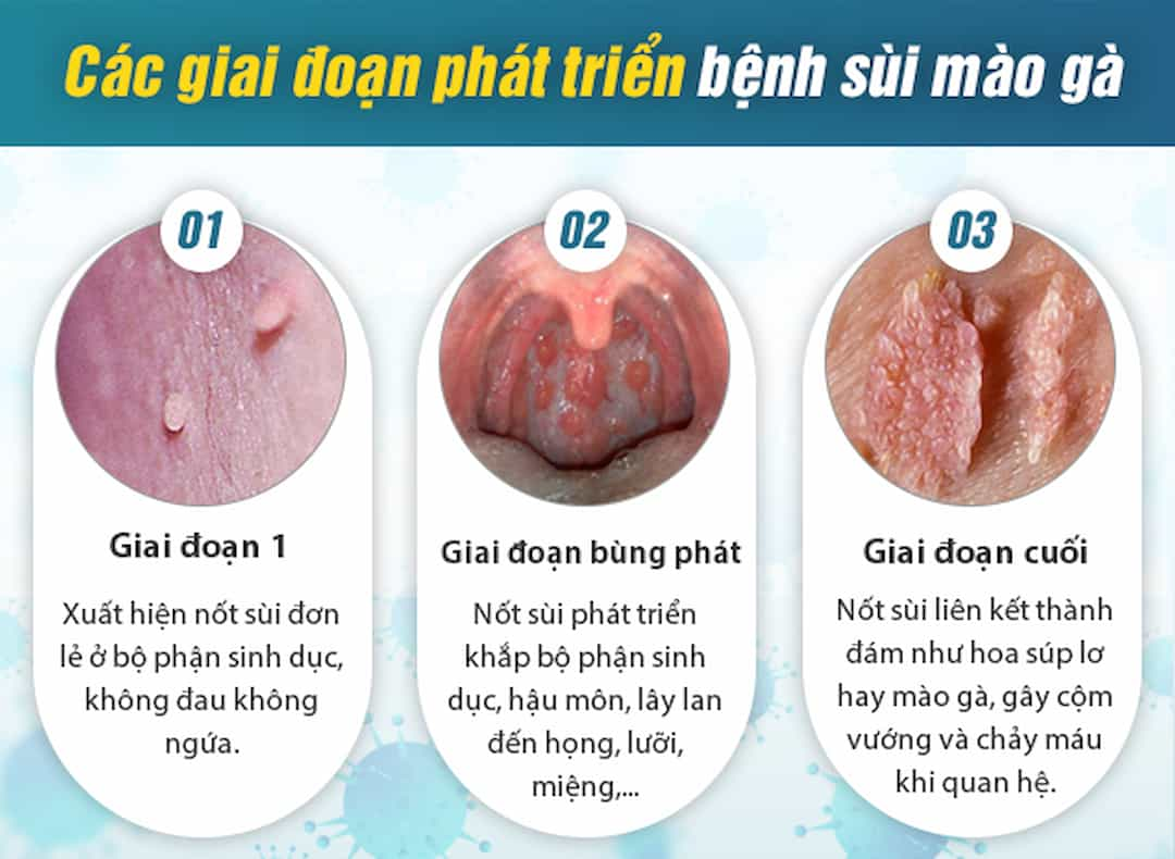 Các giai đoạn phát triển của sùi mào gà