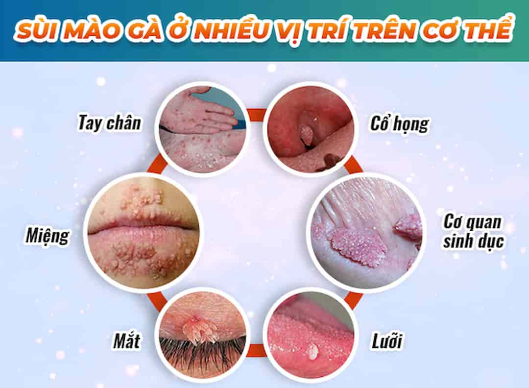 Sùi mào gà xuất hiện ở nhiều vị trí trên cơ thể