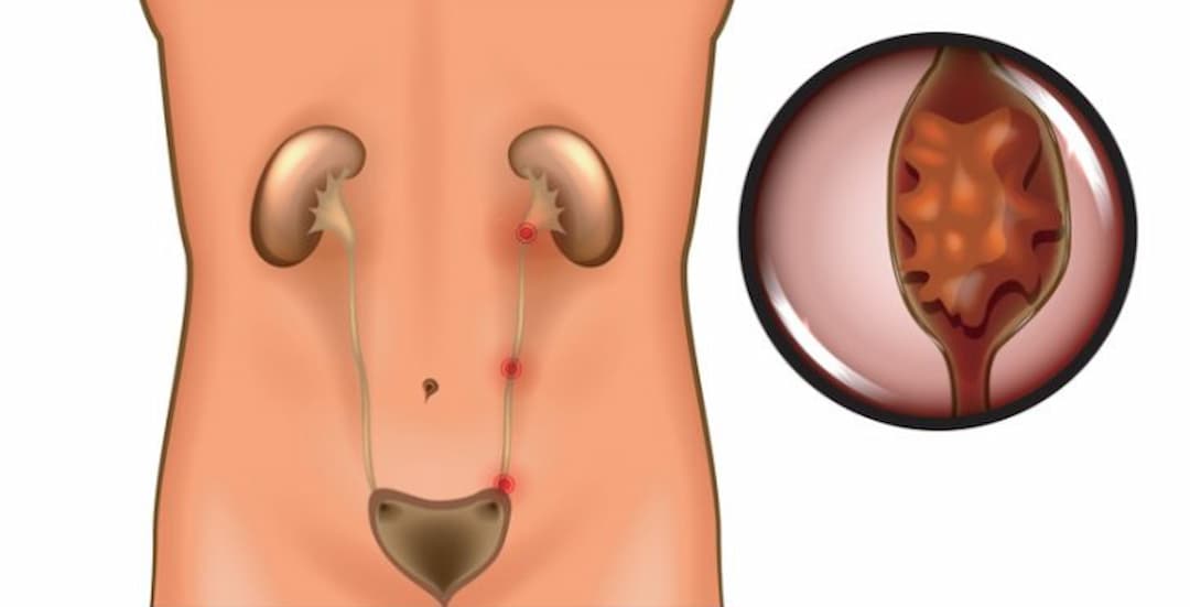 Sỏi thận đau ở đâu?