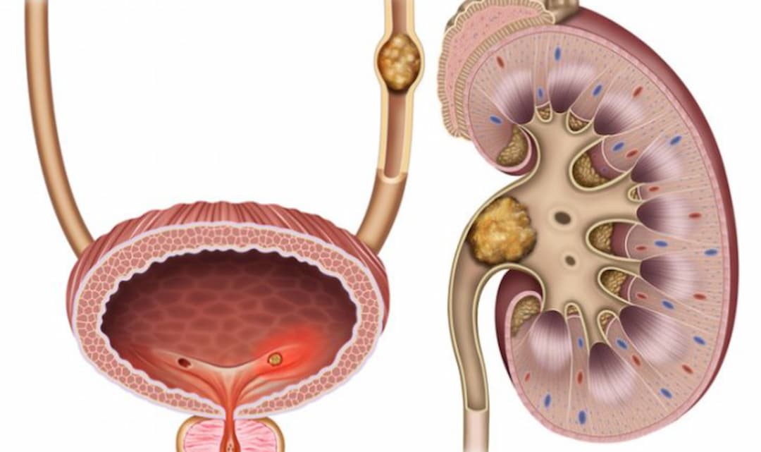 Cách giảm đau sỏi thân tại nhà hiệu quả tham khảo ngay