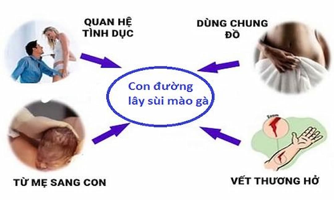 Sùi mào gà lây truyền qua các con đường