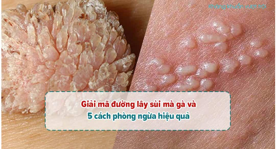 Sùi mào gà lây qua đường nào? và 5 cách phòng ngừa hiệu quả