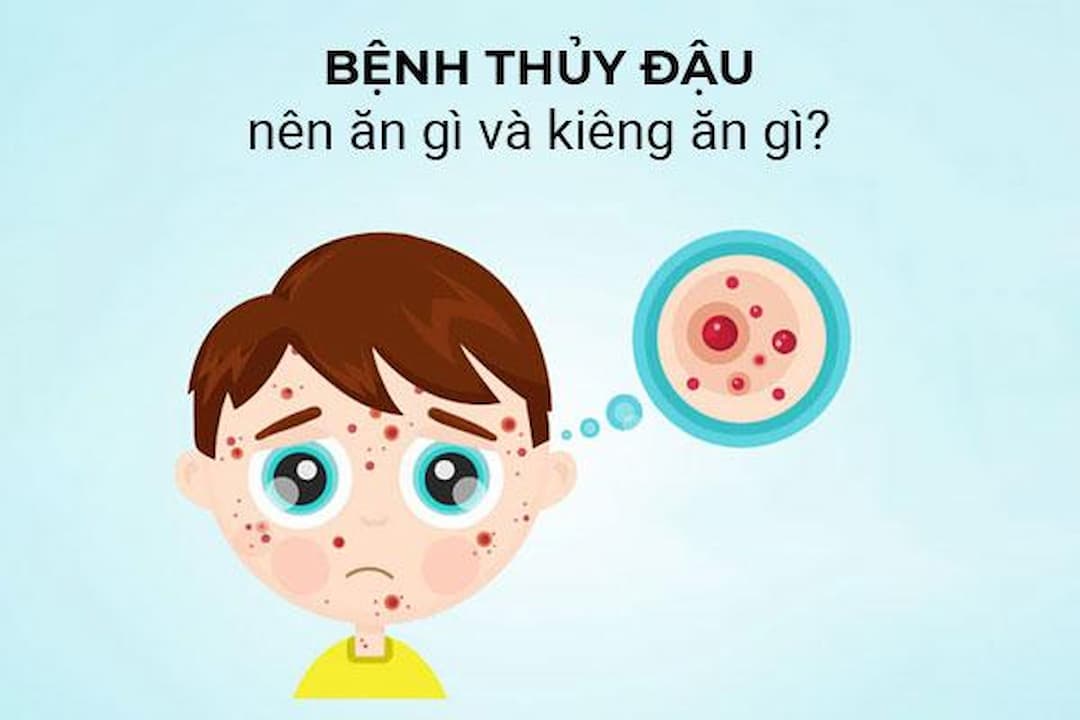 Cách phòng ngừa bệnh thủy đậu