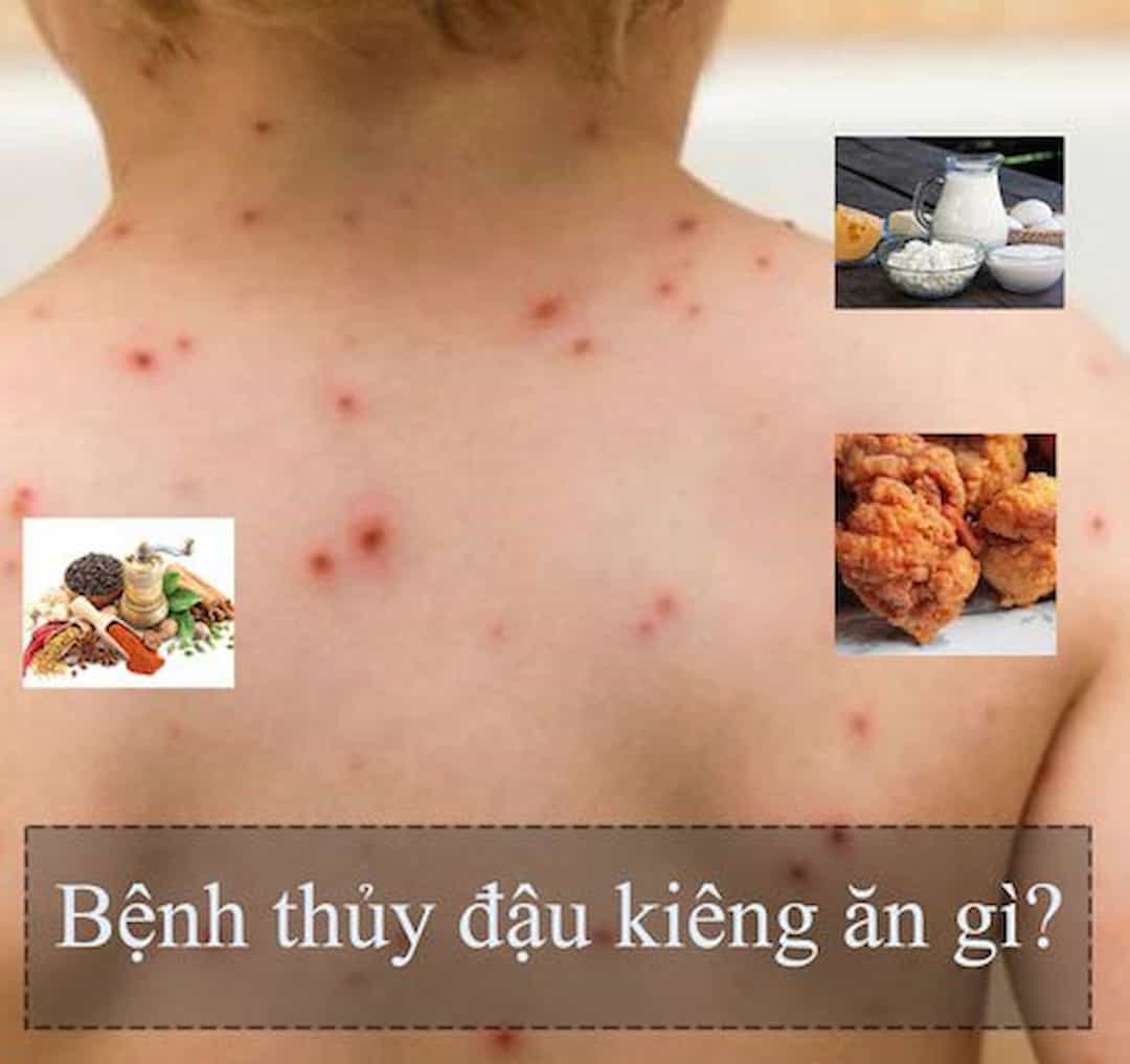 Triệu chứng của bệnh thủy đậu