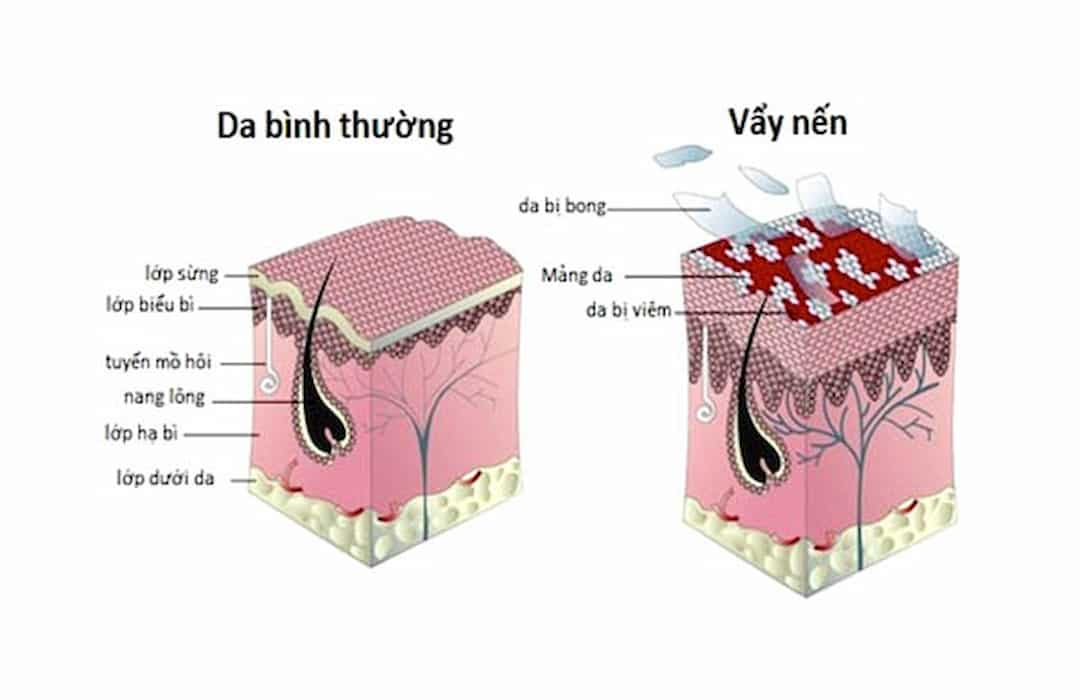 Phân loại các loại nến và các biểu hiện của bệnh vẩy nến.