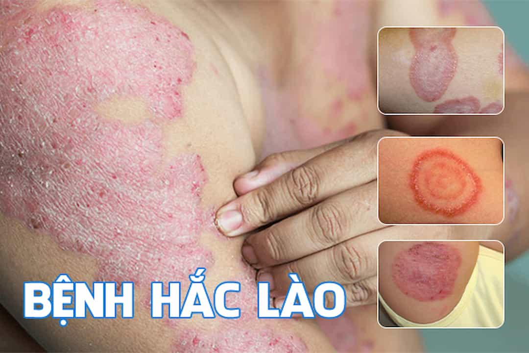 Nguy cơ bệnh hắc lào có nguy hiểm không?